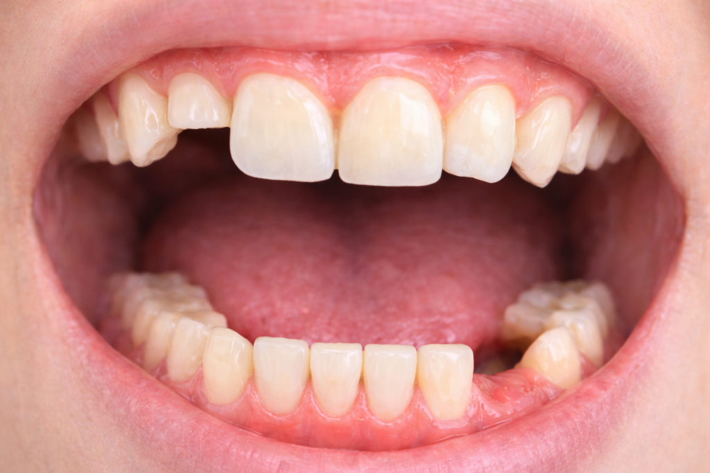 インプラントとセラミックは何が違うの？それぞれの特徴や値段、選ぶ基準などを徹底解説！