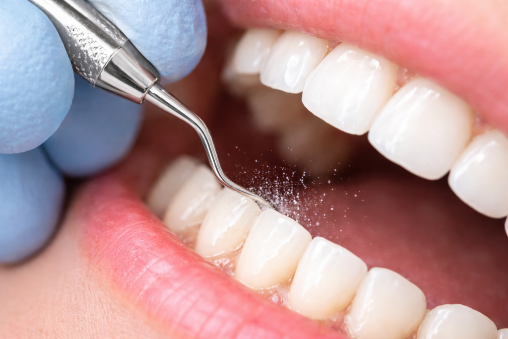 インプラントの寿命を延ばすために意識したいポイント