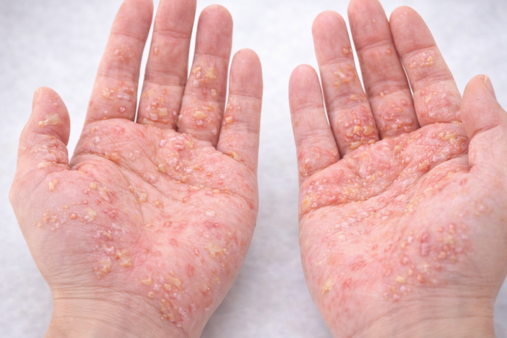 インプラント治療後に見られる可能性のある金属アレルギーの症状