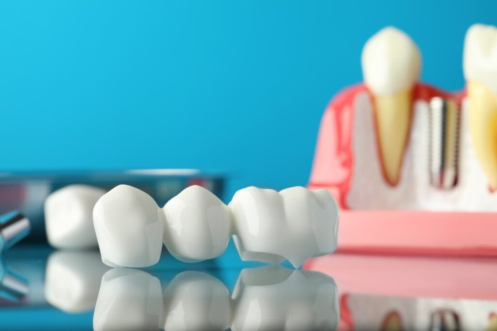歯のブリッジ治療に使用する人口歯